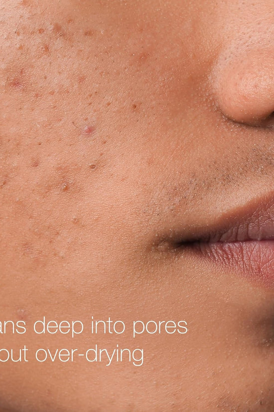 Rapid Clear Maximum Strength Acne Face Pads, for Acne Prone Skin, Salicylic Acid Treatment to Help Fight Breakouts, Oil - Free Facial Cleansing Pads with 2% Salicylic Acid Treatment, 60 Count - Velinare